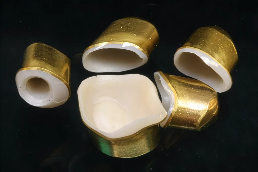 Goldene Galvanokappen auf Zirkon-Primärkronen